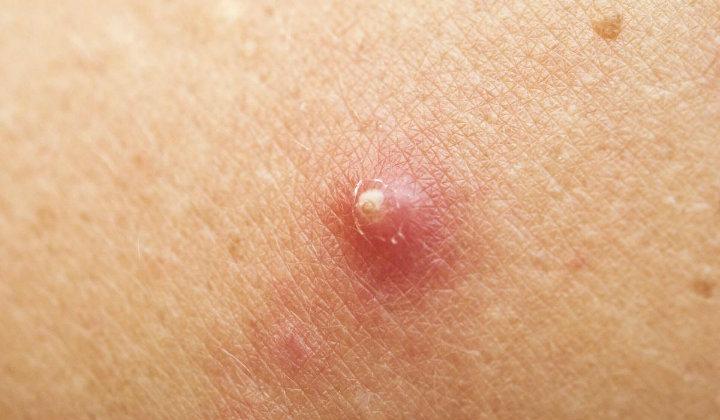 ¿Por que se hacen Abscesos y Forúnculos en mi cuerpo?