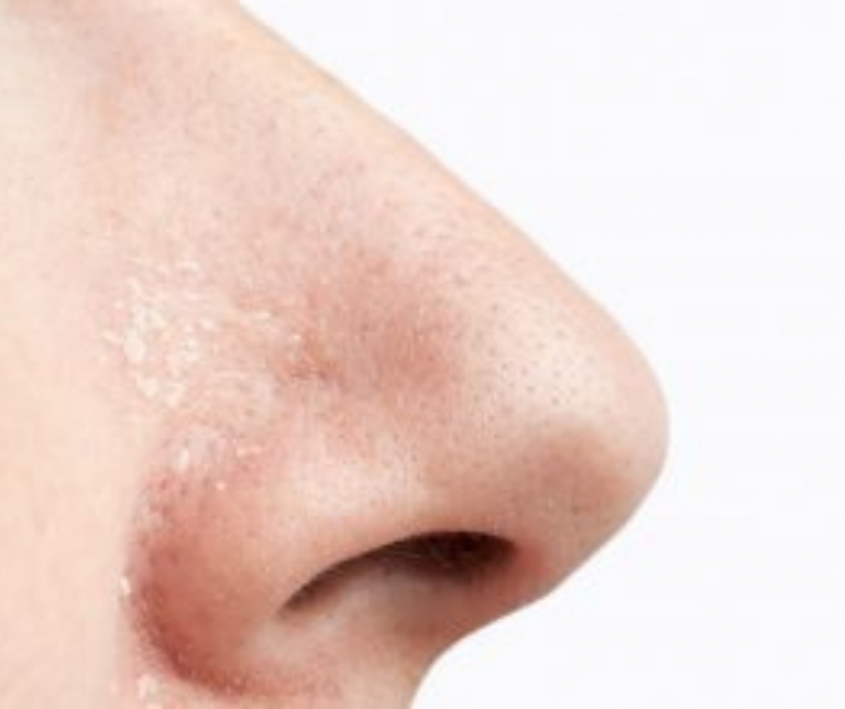 Las causas internas de la Dermatitis Seborreica en la MTC