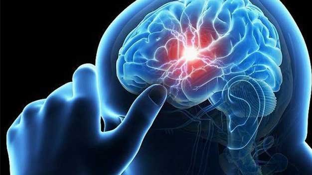 Caso práctico: ictus cerebral