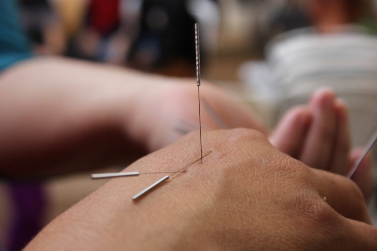 Acupuntura: técnica MTC de reconocimiento internacional