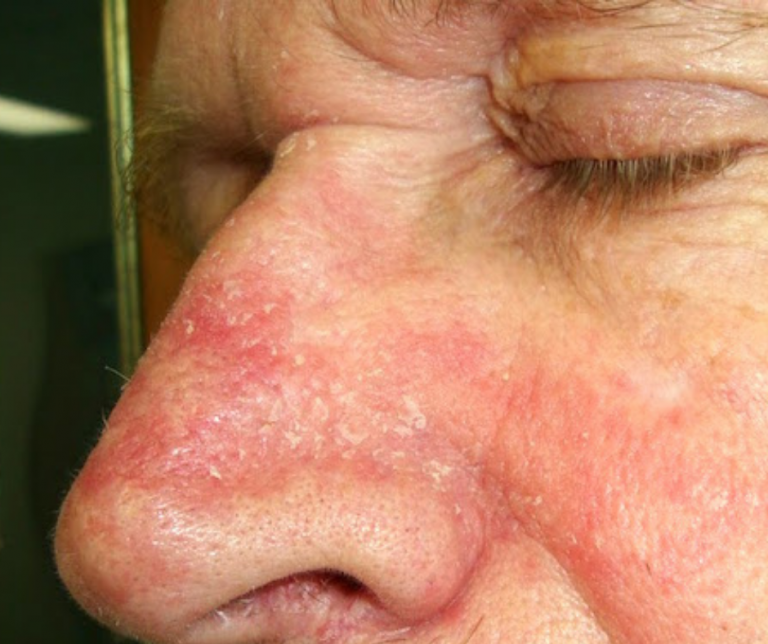 ¿Tiene la Dermatitis seborreica una causa interna? Las respuestas de la MTC