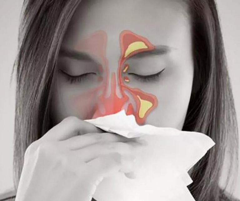 Caso práctico: Sinusitis & rinorrea