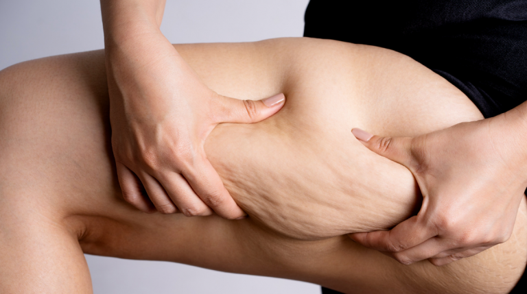 Lipedema Erlingen